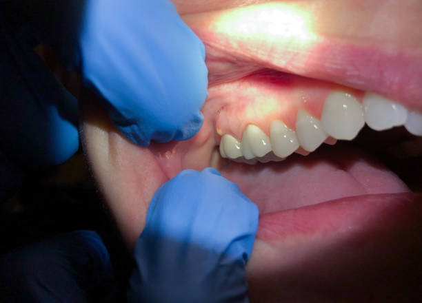 Best Dental Abscess Treatment in Oak Lawn, IL